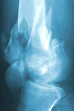 osteop interna