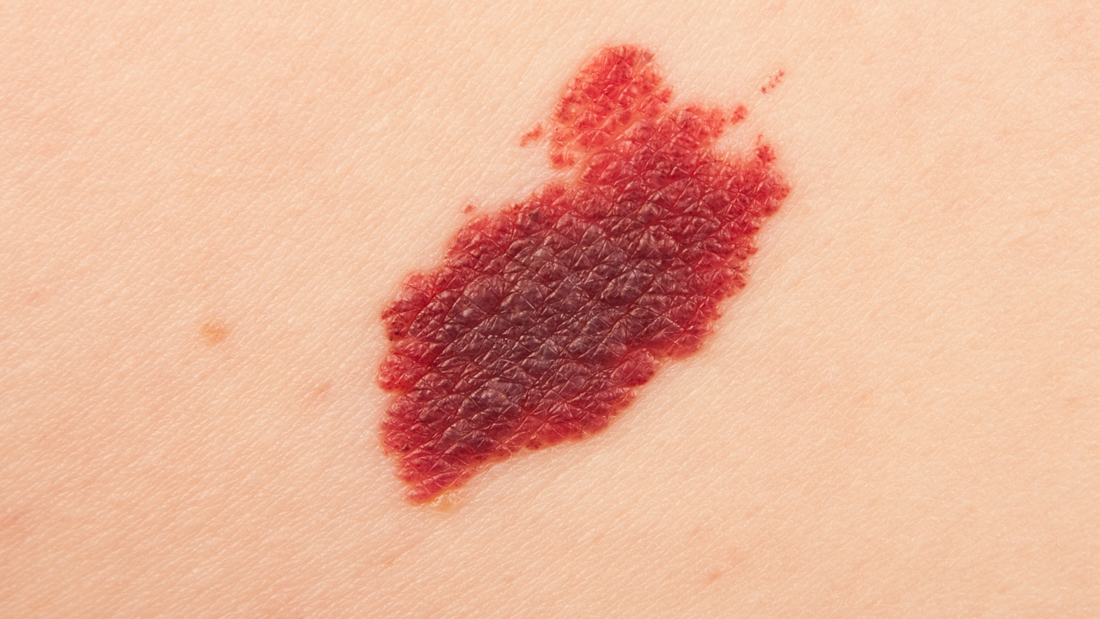 Come-si-fa-la-diagnosi-del-melanoma Diagnosi Melanoma